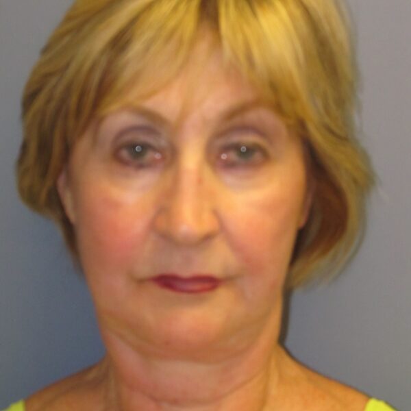 Before — 72 year old woman treated with SMAS Facelift
