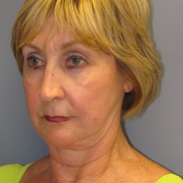 Before — 72 year old woman treated with SMAS Facelift