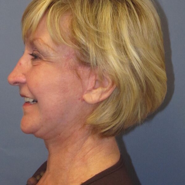After — 72 year old woman treated with SMAS Facelift