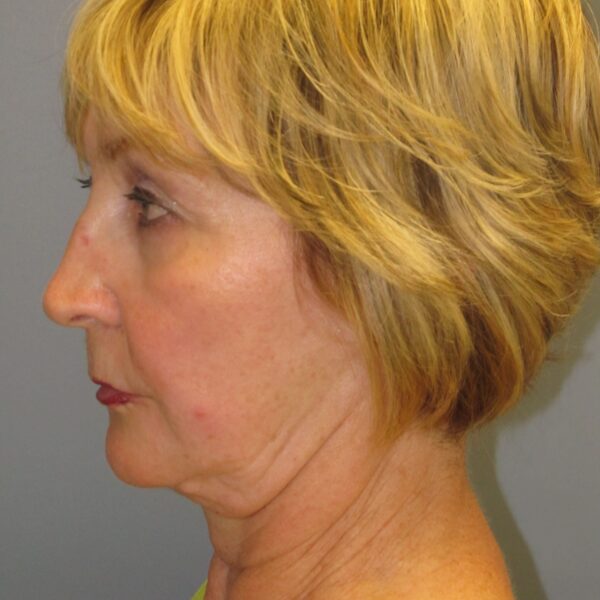 Before — 72 year old woman treated with SMAS Facelift