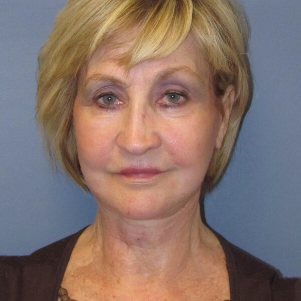 After — 72 year old woman treated with MACS Facelift