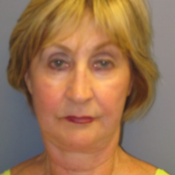 Before — 72 year old woman treated with MACS Facelift