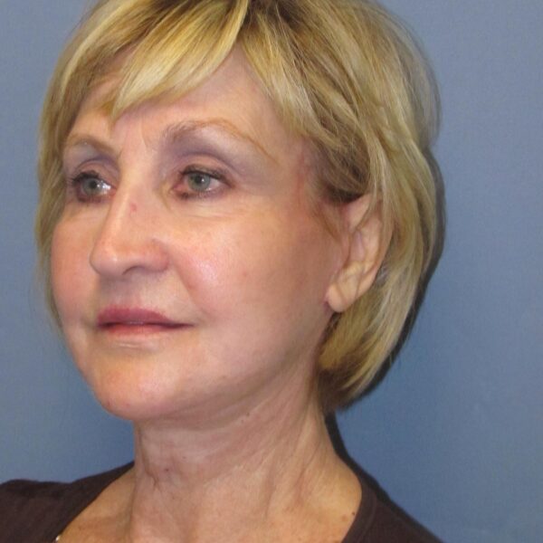 After — 72 year old woman treated with MACS Facelift