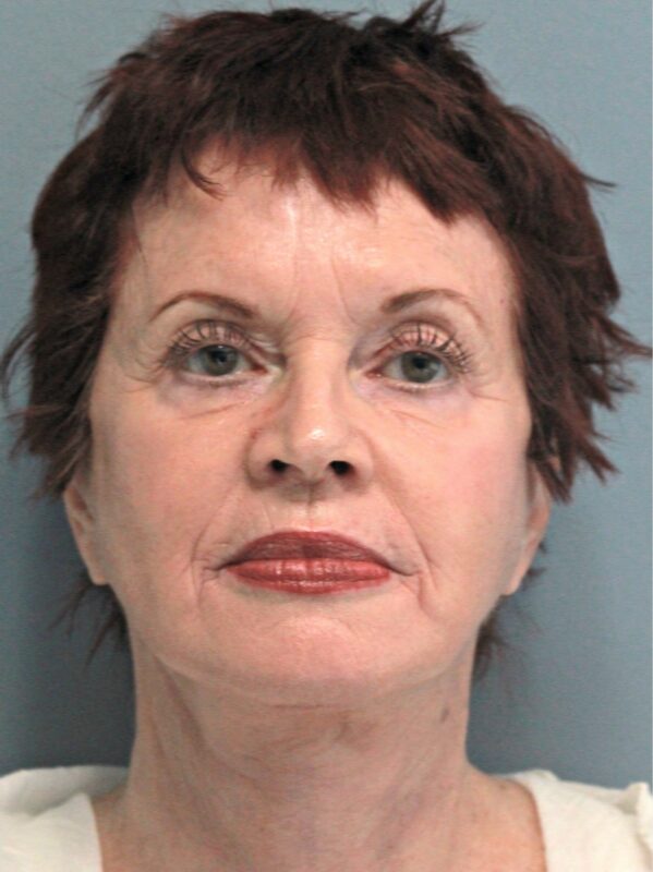 After — 68 year old woman treated with MACS Facelift