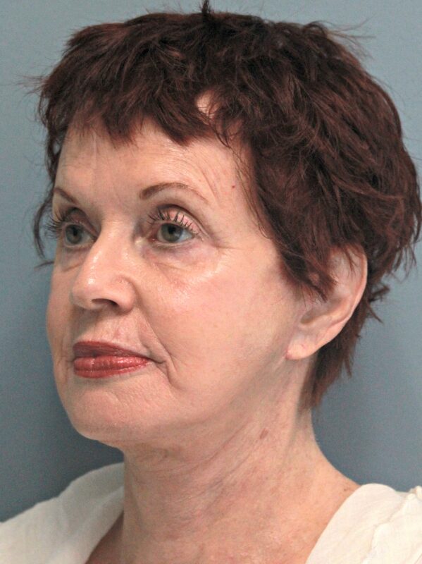 After — 68 year old woman treated with MACS Facelift