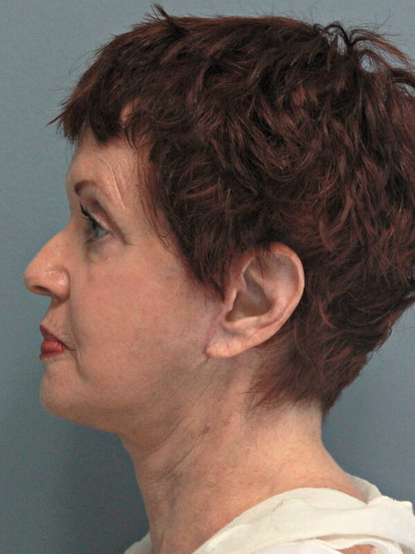 After — 68 year old woman treated with Neck Lift