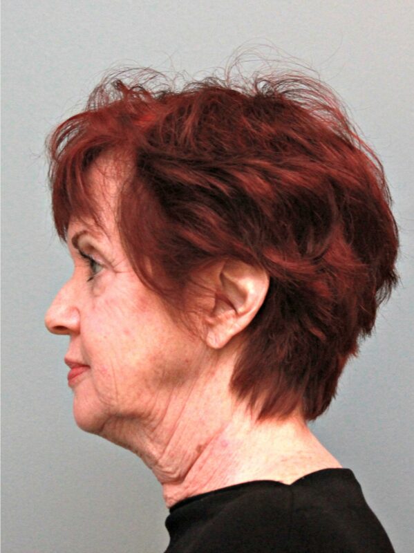 Before — 68 year old woman treated with SMAS Facelift
