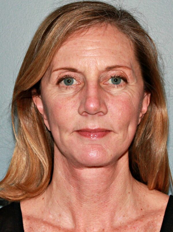 After — 46 year old woman treated with Chin Implant