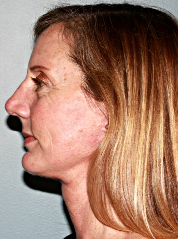 After — 46 year old woman treated with Chin Implant