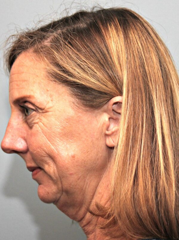 Before — 46 year old woman treated with Chin Implant