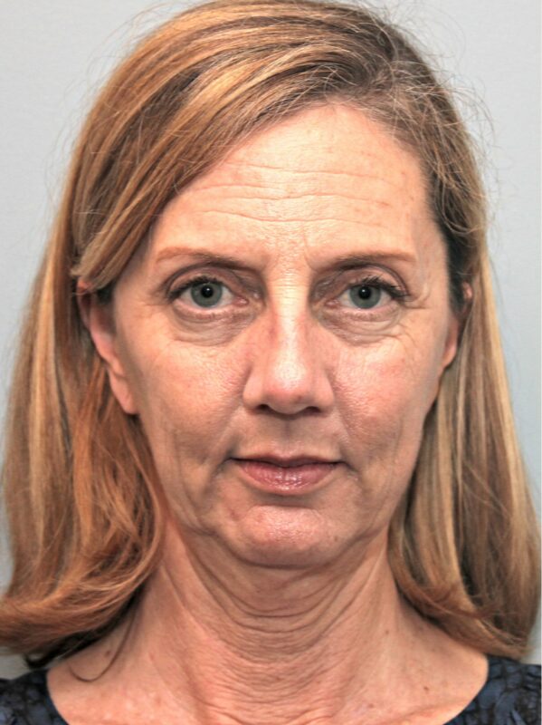 Before — 46 year old woman treated with Chin Surgery