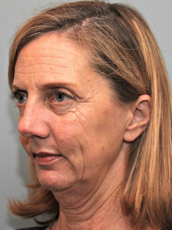Before — 46 year old woman treated with Chin Surgery
