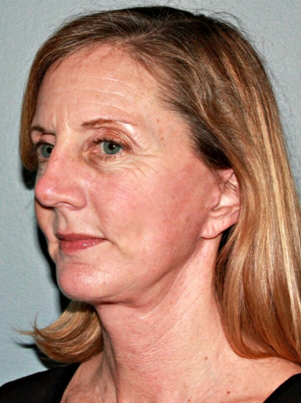 After — 46 year old woman treated with Lower Face Lift