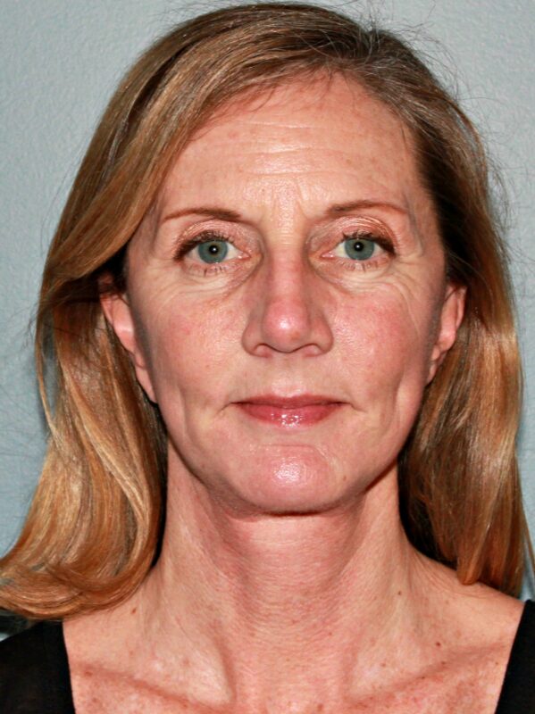 After — 46 year old woman treated with MACS Facelift
