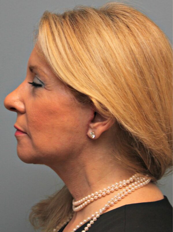 After — 46 year old woman treated with MACS Facelift