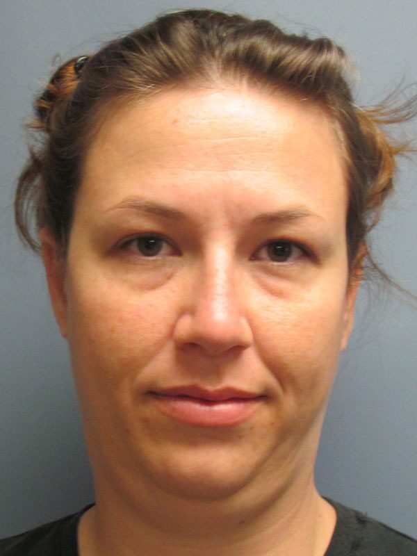 Before — Chin Augmentation on 32-year-old