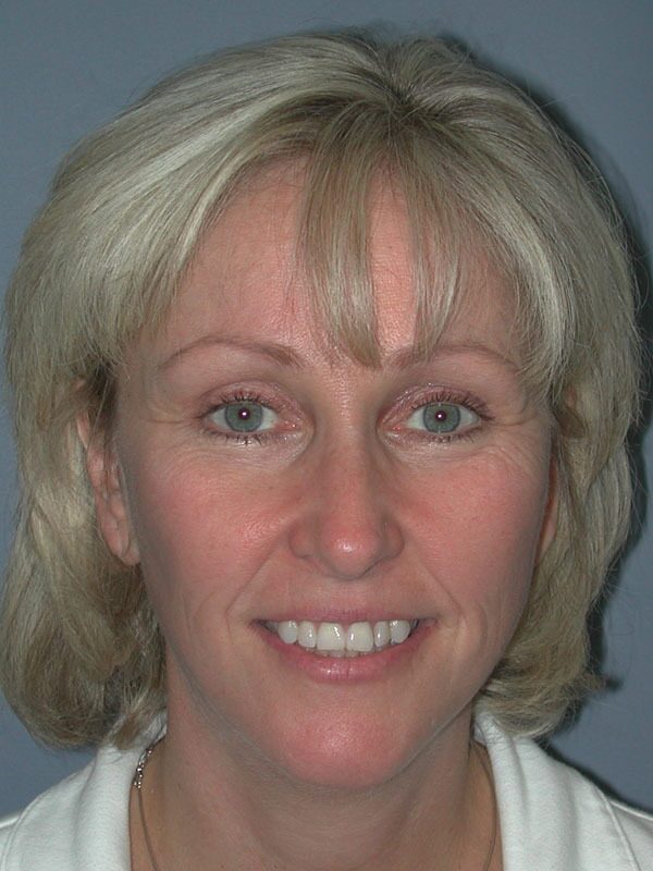 After — Chin Surgery/Augmentation on 46-year-old