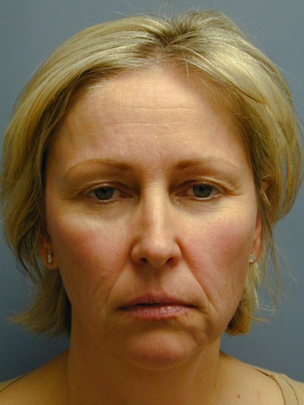 Before — Chin Surgery/Augmentation on 46-year-old