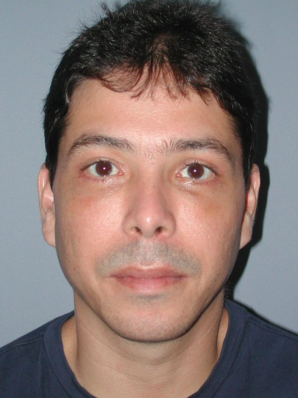 After — Chin Augmentation, Chin Surgery