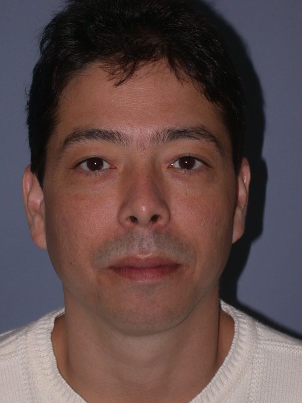 Before — Chin Augmentation, Chin Surgery