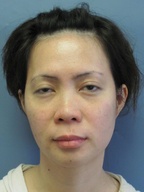 Before — Chin Surgery on 32-year-old