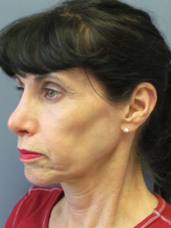 Before — Chin Surgery on 65-year-old