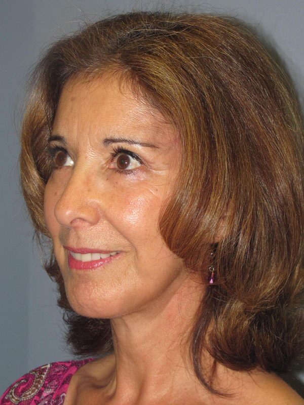 After — Chin Surgery on 62-year-old