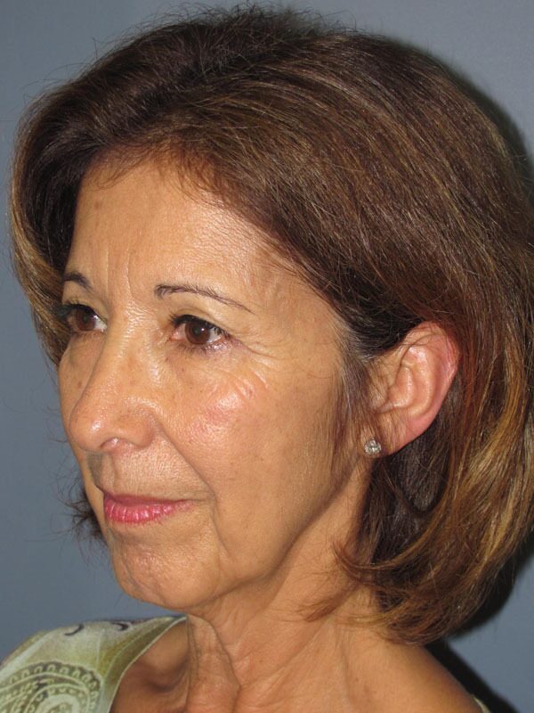 Before — Chin Surgery on 62-year-old