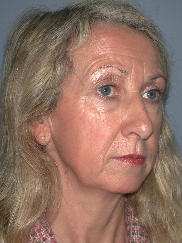 Before — Chin Augmentation on 53-year-old