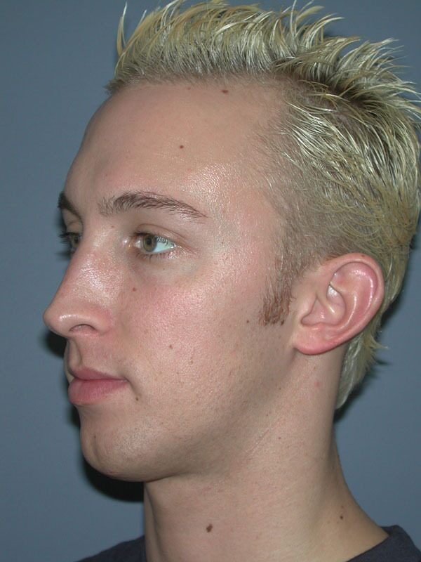 Before — Chin Surgery on 28-year-old