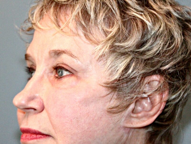 After — 68 year old woman treated with Double Eyelid Surgery