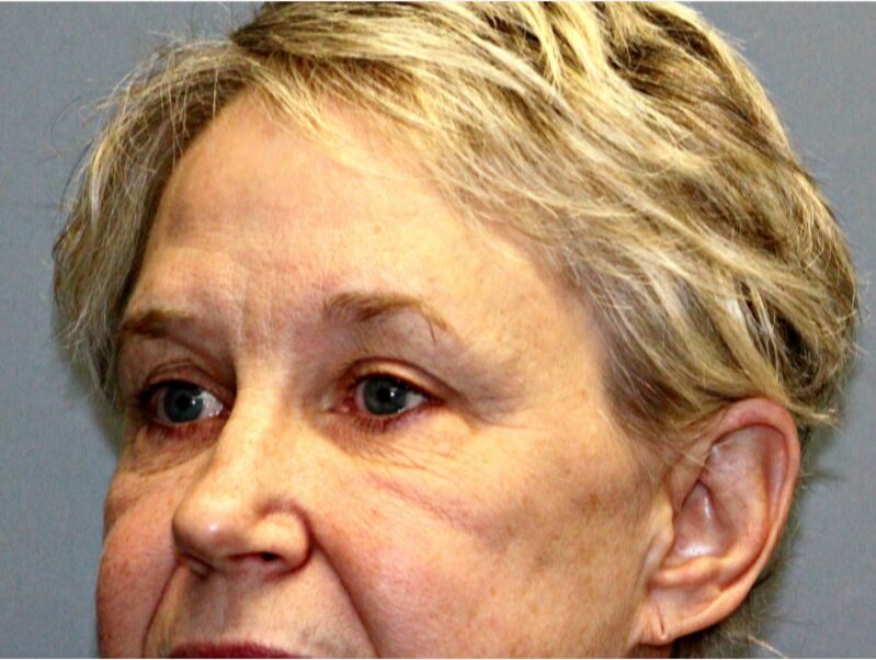 Before — 68 year old woman treated with Double Eyelid Surgery