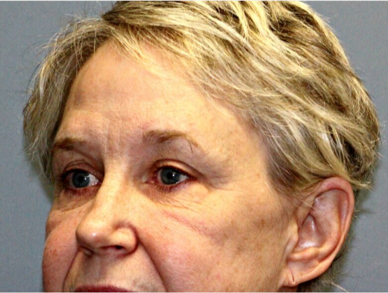 Before — 65-74 year old woman treated with Double Eyelid Surgery