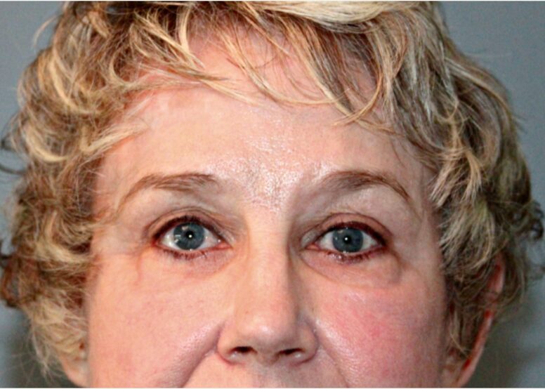 After — 68 year old woman treated with Eyelid Surgery