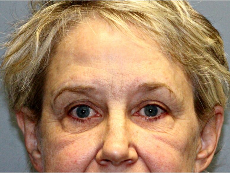 Before — 68 year old woman treated with Eyelid Surgery