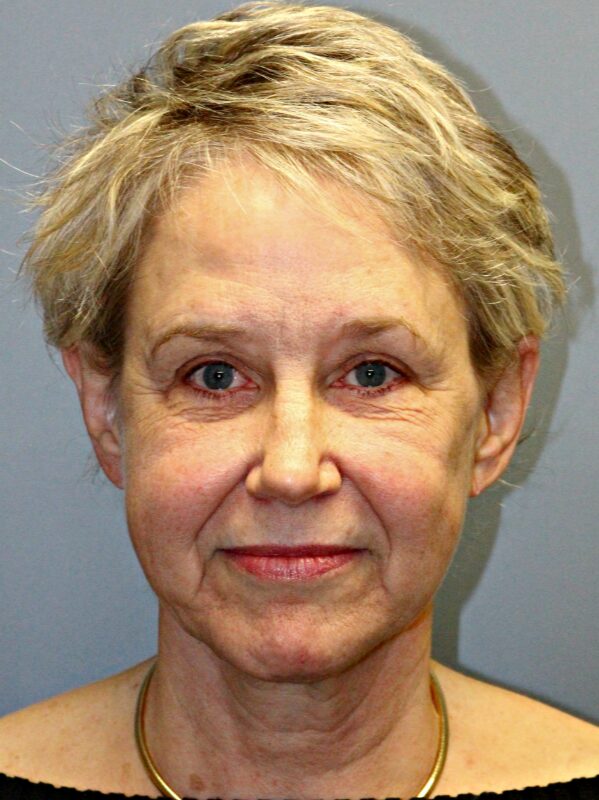 Before — 68 year old woman treated with Facial Fat Transfer