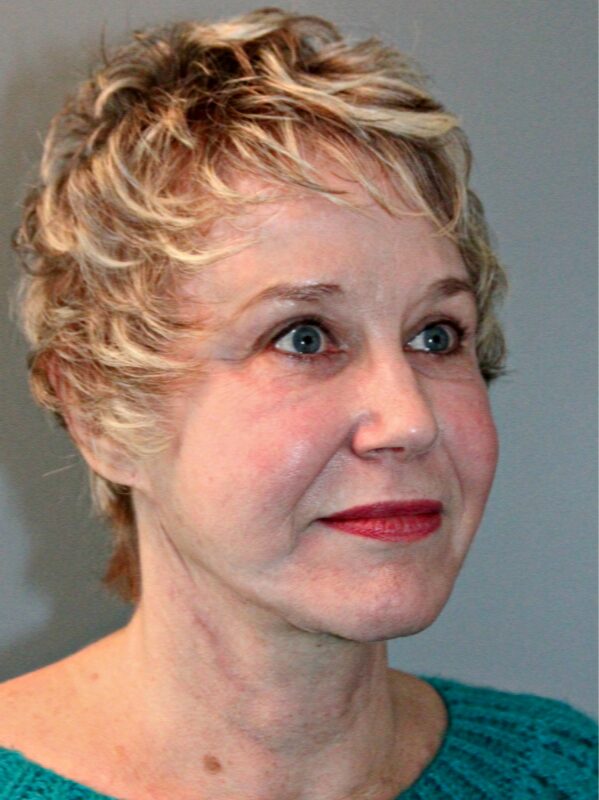 After — 68 year old woman treated with Facial Fat Transfer