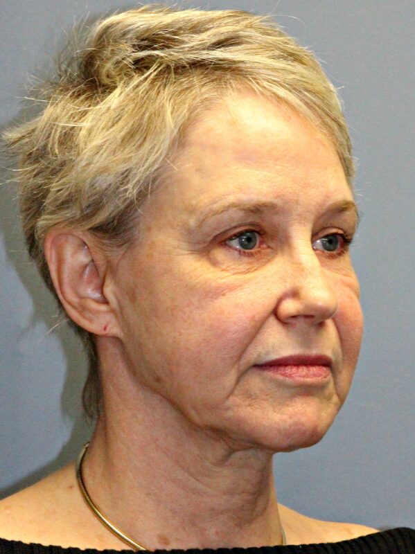 Before — 68 year old woman treated with Facial Fat Transfer