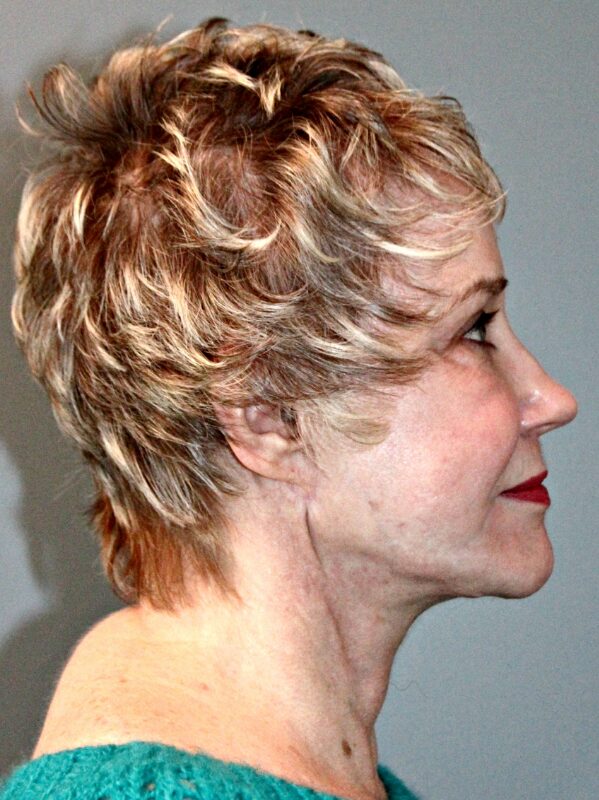 After — 68 year old woman treated with Lifestyle Lift