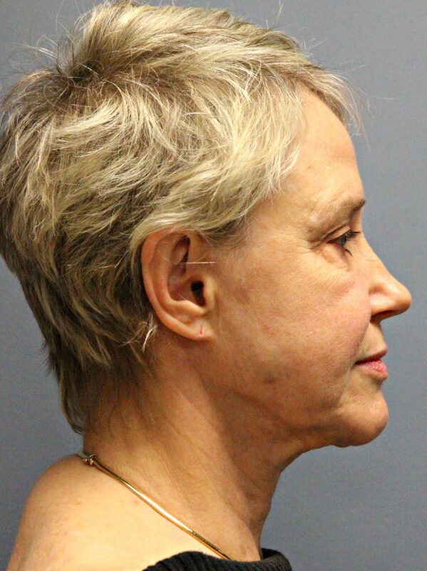 Before — 68 year old woman treated with Lifestyle Lift