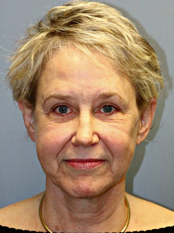 Before — 68 year old woman treated with MACS Facelift