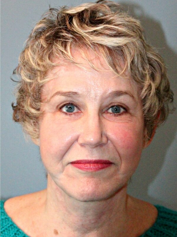 After — 68 year old woman treated with SMAS Facelift