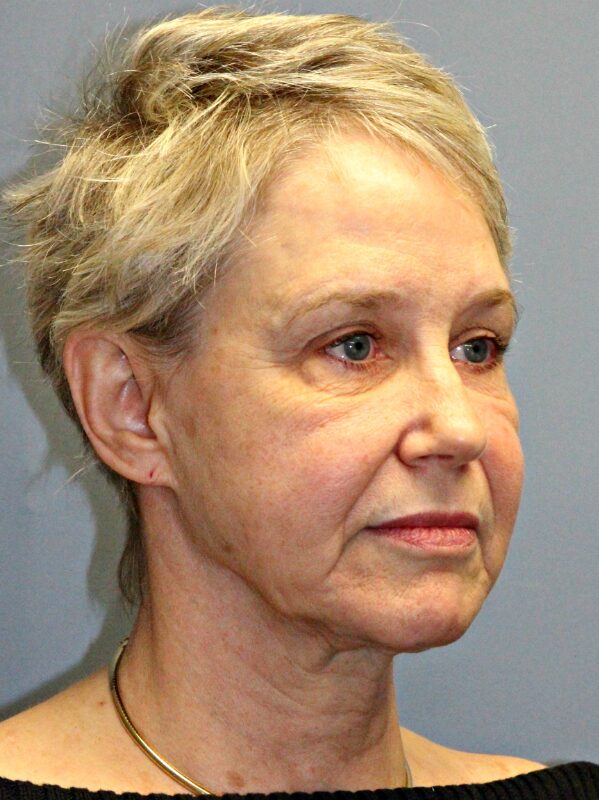 Before — 68 year old woman treated with SMAS Facelift