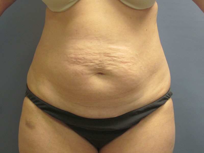 Before — Tummy Tuck/ Abdominoplasty on 42-year-old