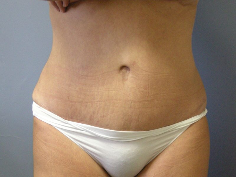 After — Tummy Tuck on 36-year-old