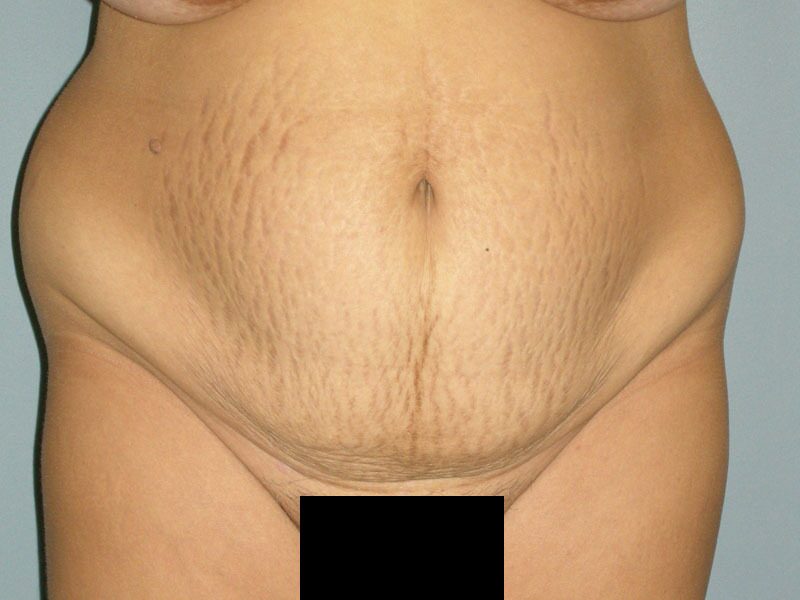 Before — Tummy Tuck on 36-year-old