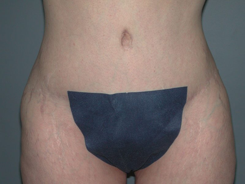 After — Tummy Tuck on 35-year-old