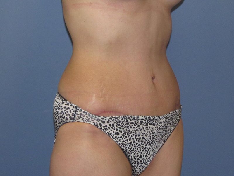 After — Tummy Tuck on 44-year-old