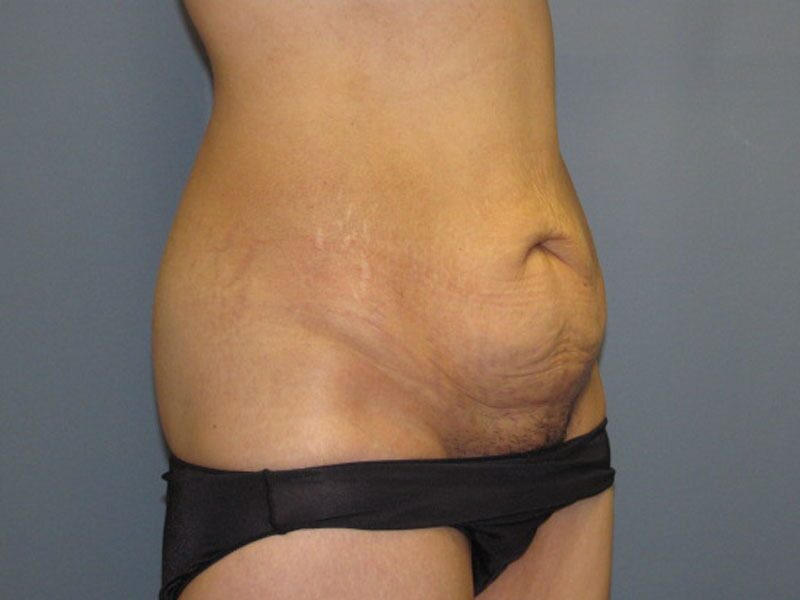 Before — Tummy Tuck on 44-year-old