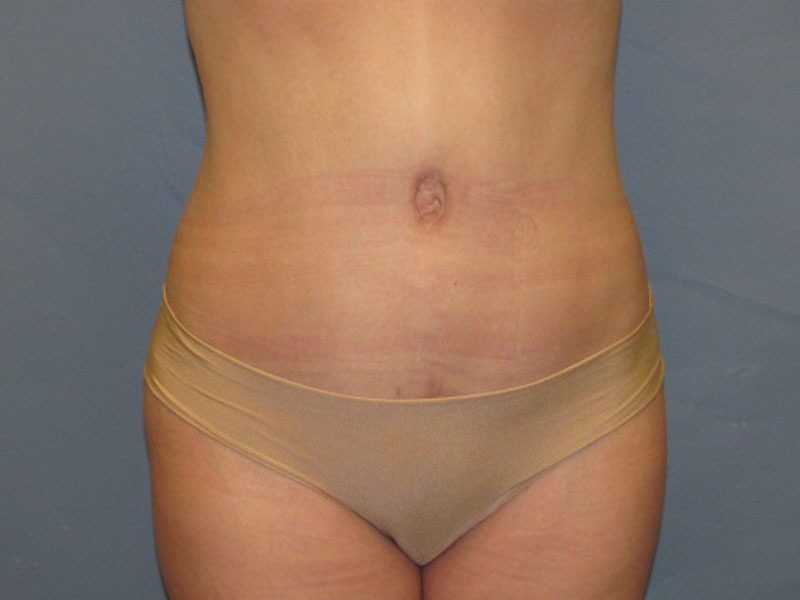 After — Tummy Tuck on 35-year-old